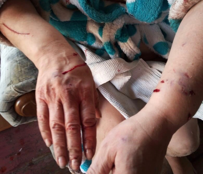 Соцсети: в Полянах свободно разгуливающий алабай напал на женщину